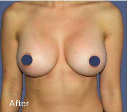 Breast Augmentation Before & After Patient #9115