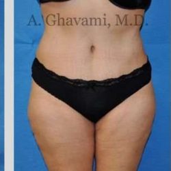 Abdominoplasty Before & After Patient #8228