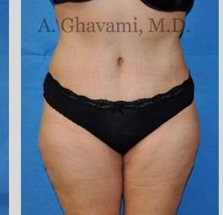 Abdominoplasty Before & After Patient #8228