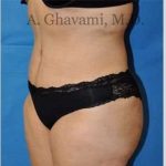 Abdominoplasty Before & After Patient #8228
