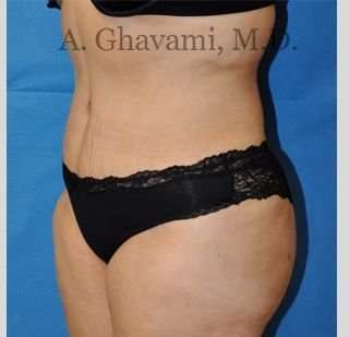 Abdominoplasty Before & After Patient #8228