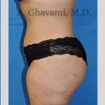 Abdominoplasty Before & After Patient #8228