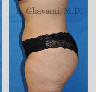 Abdominoplasty Before & After Patient #8228