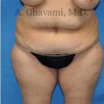 Abdominoplasty Before & After Patient #8228