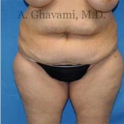 Abdominoplasty Before & After Patient #8228
