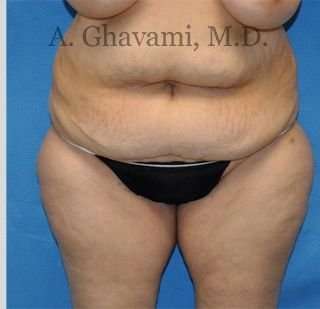 Abdominoplasty Before & After Patient #8228