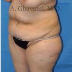 Abdominoplasty Before & After Patient #8228