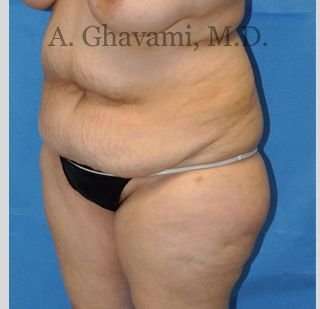 Abdominoplasty Before & After Patient #8228