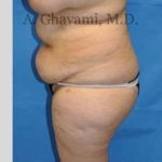 Abdominoplasty Before & After Patient #8228