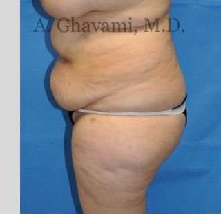 Abdominoplasty Before & After Patient #8228