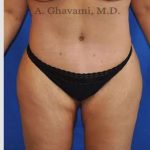 Abdominoplasty Before & After Patient #8221