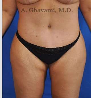 Abdominoplasty Before & After Patient #8221