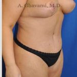 Abdominoplasty Before & After Patient #8221