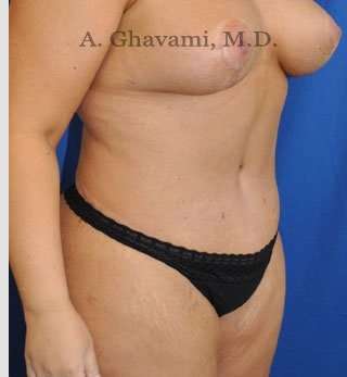 Abdominoplasty Before & After Patient #8221