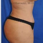 Abdominoplasty Before & After Patient #8221