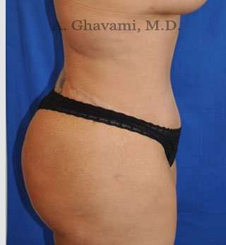 Abdominoplasty Before & After Patient #8221