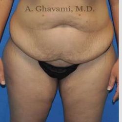 Abdominoplasty Before & After Patient #8221