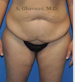 Abdominoplasty Before & After Patient #8221