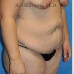 Abdominoplasty Before & After Patient #8221