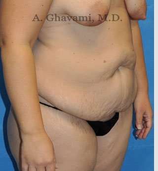 Abdominoplasty Before & After Patient #8221