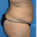 Abdominoplasty Before & After Patient #8221