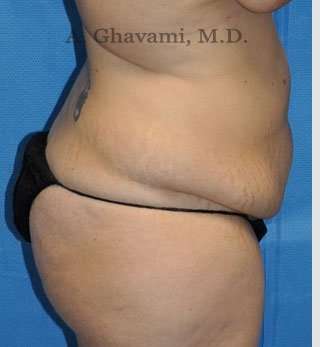 Abdominoplasty Before & After Patient #8221