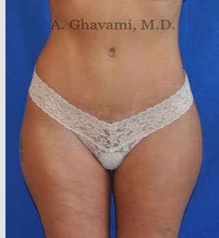 Abdominoplasty Before & After Patient #8214