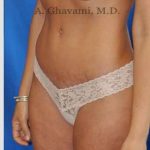 Abdominoplasty Before & After Patient #8214