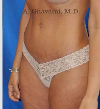 Abdominoplasty Before & After Patient #8214