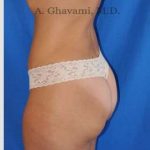 Abdominoplasty Before & After Patient #8214