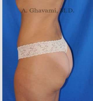 Abdominoplasty Before & After Patient #8214