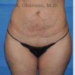 Abdominoplasty Before & After Patient #8214