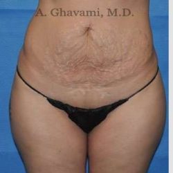 Abdominoplasty Before & After Patient #8214