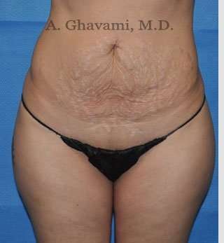 Abdominoplasty Before & After Patient #8214