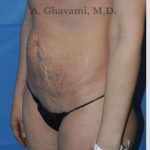 Abdominoplasty Before & After Patient #8214