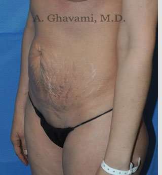 Abdominoplasty Before & After Patient #8214