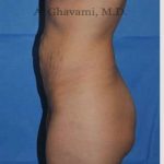 Abdominoplasty Before & After Patient #8214