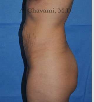Abdominoplasty Before & After Patient #8214