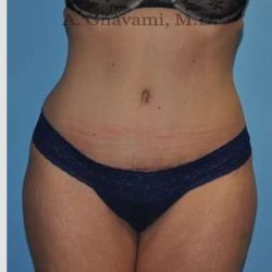 Abdominoplasty Before & After Patient #8207