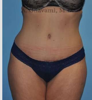 Abdominoplasty Before & After Patient #8207