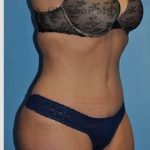 Abdominoplasty Before & After Patient #8207