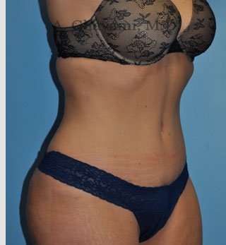 Abdominoplasty Before & After Patient #8207