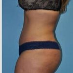 Abdominoplasty Before & After Patient #8207
