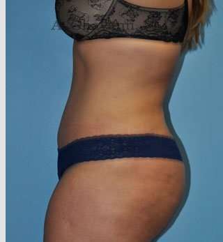 Abdominoplasty Before & After Patient #8207