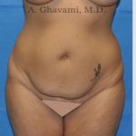 Abdominoplasty Before & After Patient #8207