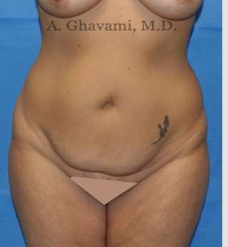 Abdominoplasty Before & After Patient #8207