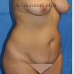 Abdominoplasty Before & After Patient #8207
