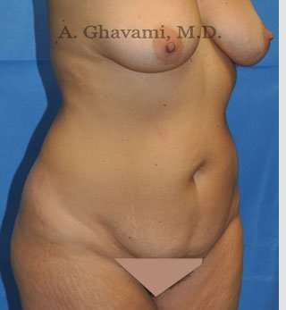 Abdominoplasty Before & After Patient #8207