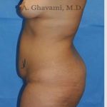 Abdominoplasty Before & After Patient #8207