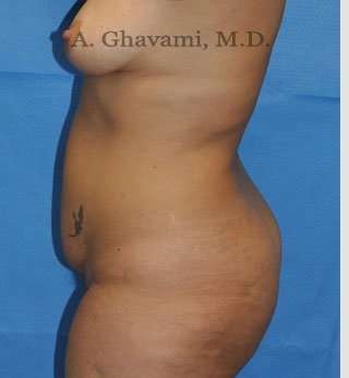 Abdominoplasty Before & After Patient #8207